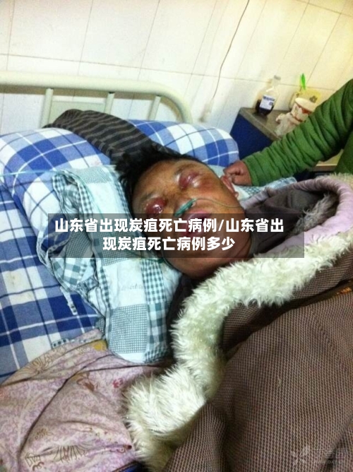 山东省出现炭疽死亡病例/山东省出现炭疽死亡病例多少